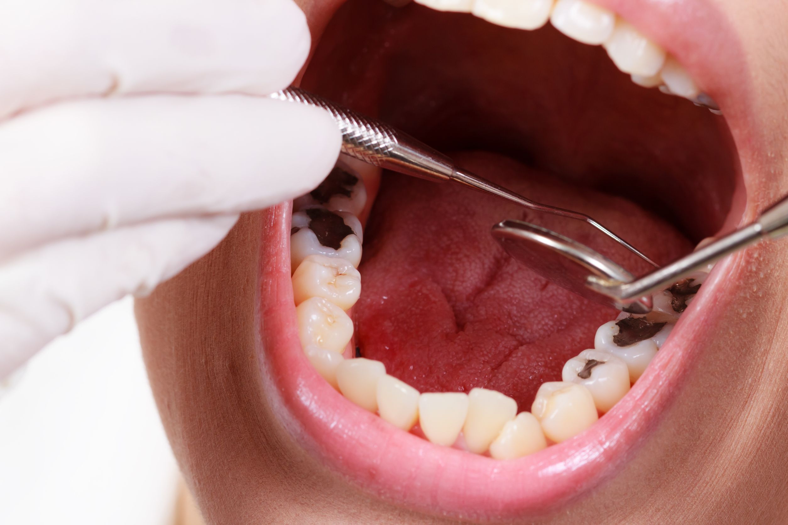 Your Questions Answered About A Dental Crown Procedure In Kona