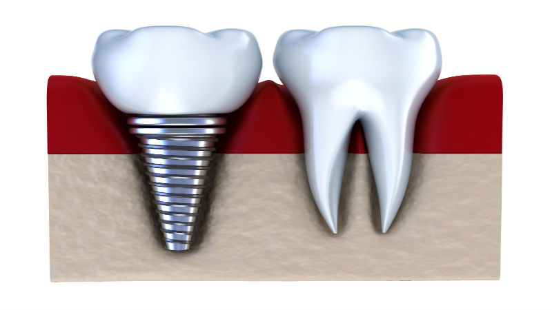 Dental Implants in Kalamazoo MI Can Greatly Improve a Person’s Smile