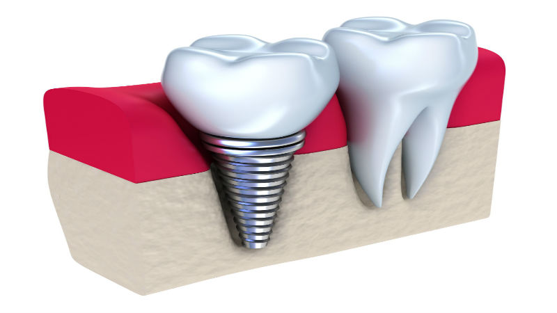 Replace Missing Teeth With Teeth Implant Services in Nassau County NY