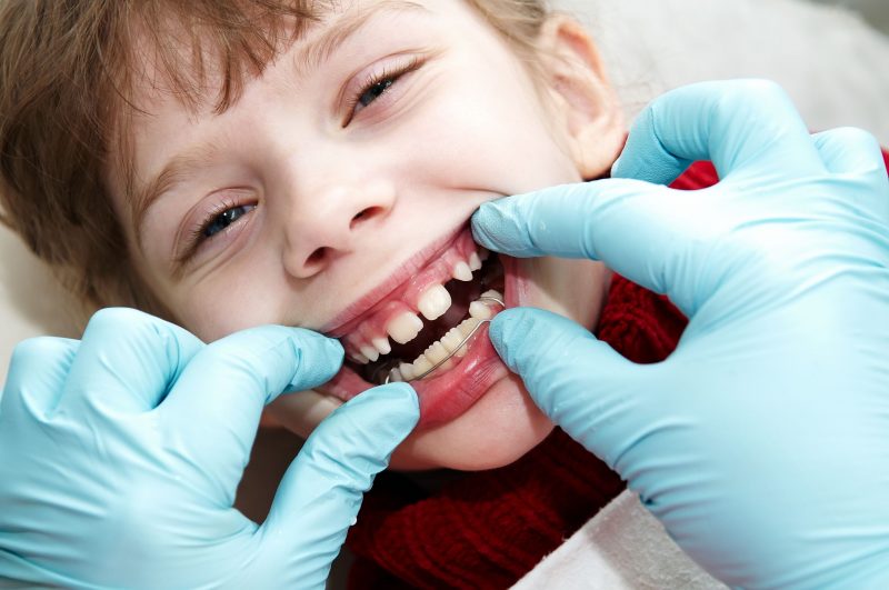 Your Cracked Tooth Can Be Repaired With Tooth Bonding in Del City OK