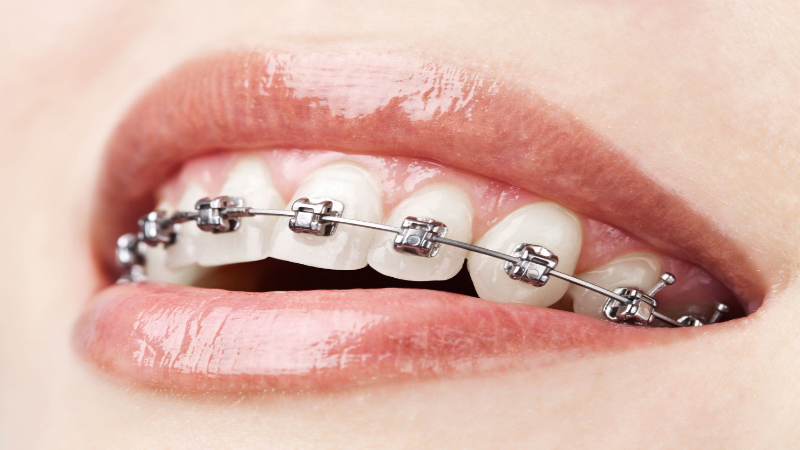 Do Invisalign Clear Aligners Work as Well as Metal Braces?