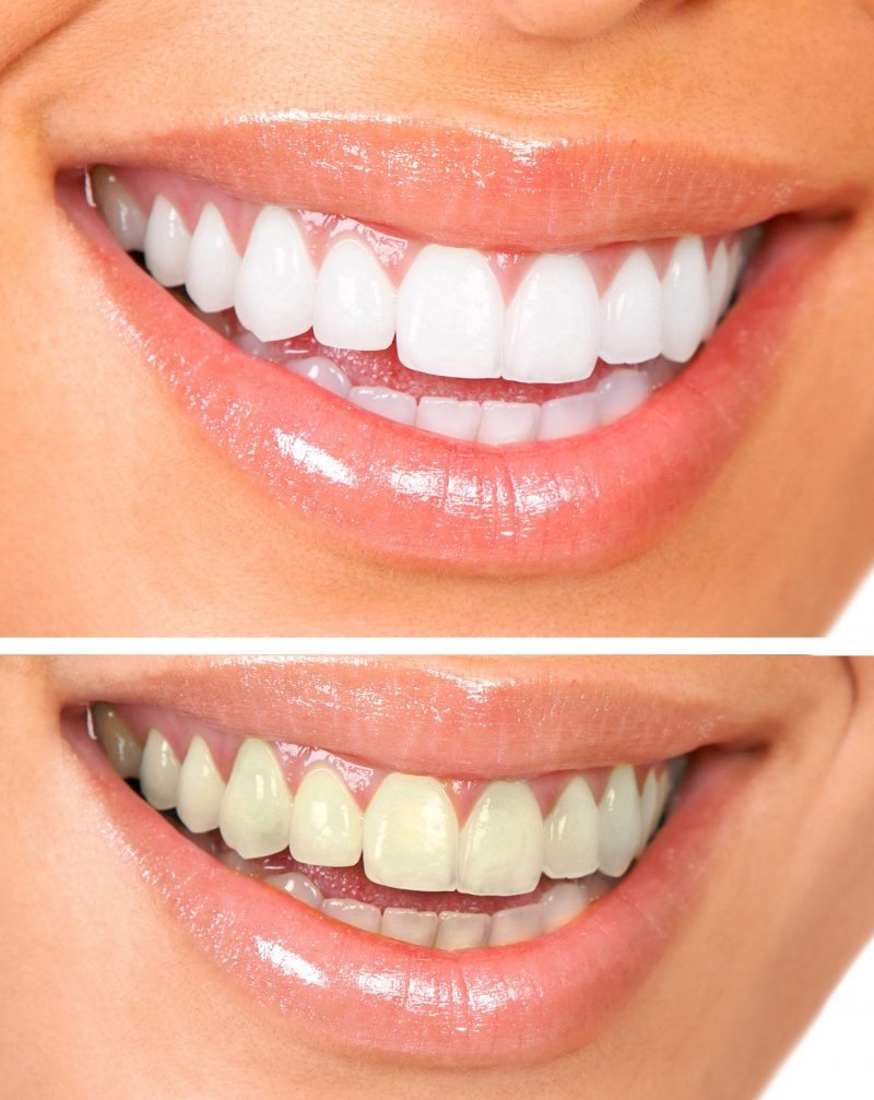 Teeth Whitening for Whiter Teeth and a Beautiful Smile