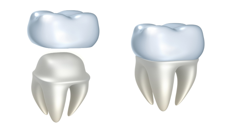 Dental Implants In Sydney: The Advantages