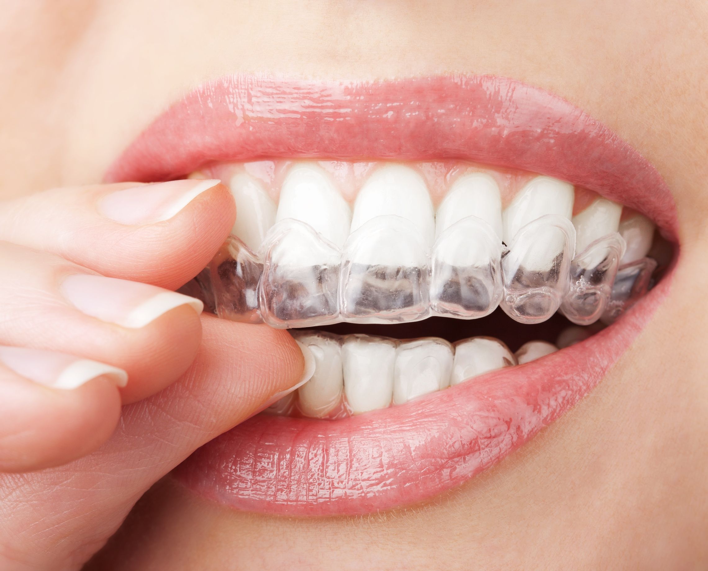 Are You a Good Candidate for Invisalign Braces?