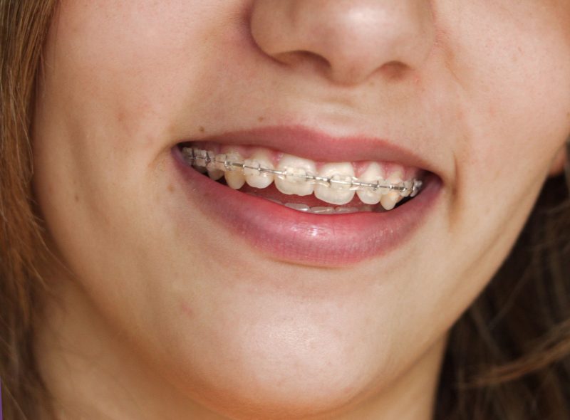 Advantages Offered by Invisalign in Annapolis Over Traditional Braces