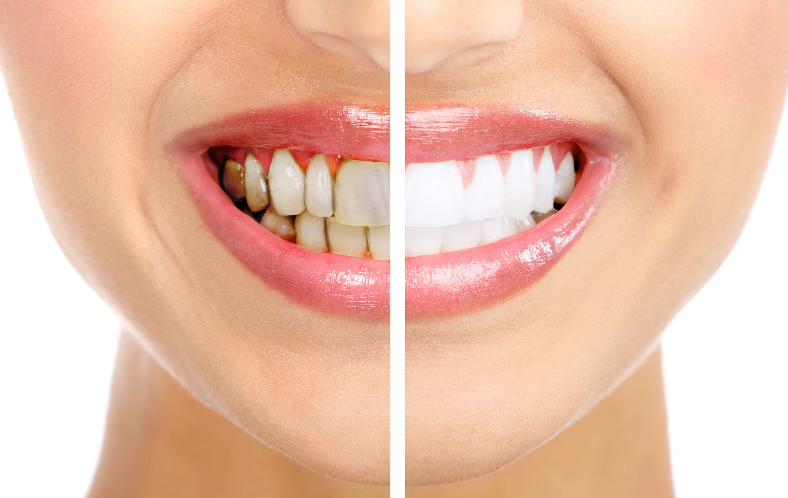 Smile Care Family & Cosmetic Dentistry In West Fargo ND Will Keep Your Smile Looking Great