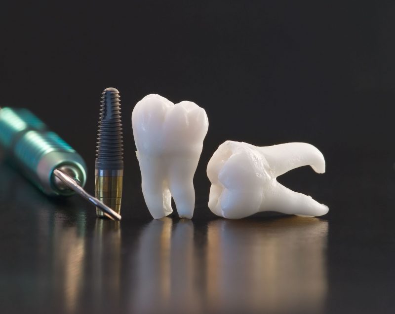 Three Advantages Of Dental Implants In Annapolis Over Dentures