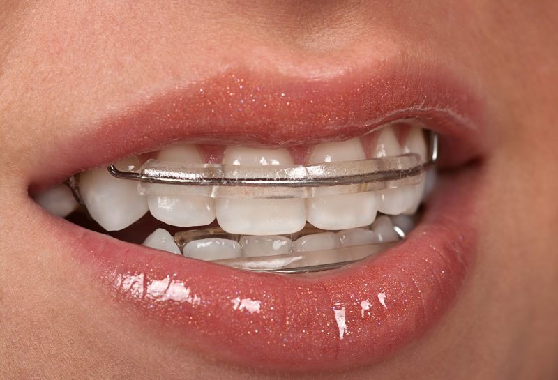 Invisalign: What to Know Before You Get Those Trays